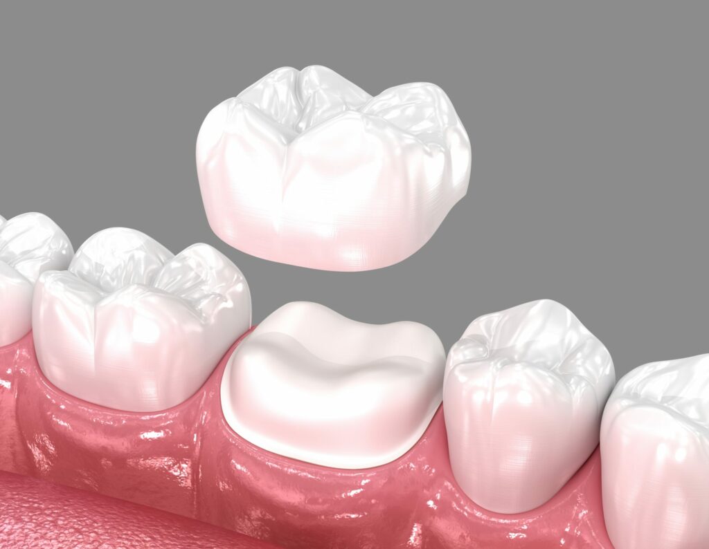 Is It Time for a Dental Crown? Subtle Warning Signs You Shouldn’t Ignore